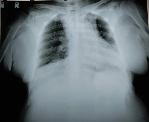 Kardiyomegali Olan Yaşlı Kadınların Göğüs Röntgeni Stok Fotoğraf