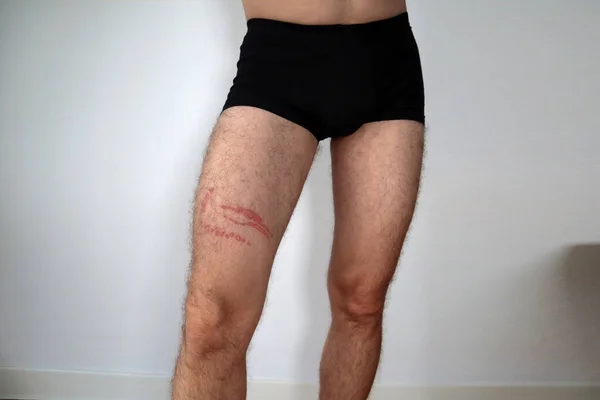 Eine Qualle Sticht Einem Mann Ins Bein — Stockfoto