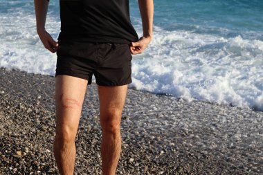 Bir denizanası bir adamın bacağını yakar, sahilde.