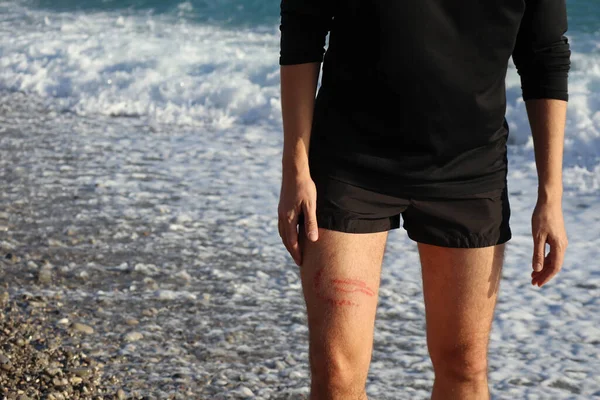 Una Puntura Medusa Brucia Sulla Gamba Uomo Sulla Spiaggia — Foto Stock