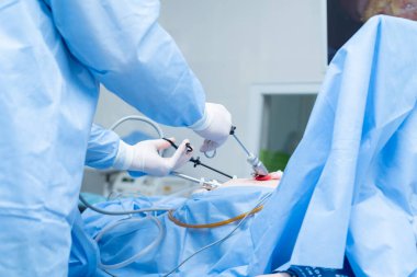 Abdominal ameliyat, laparoskopi, kolesistektomi, safra kesesi alınması endoskop ve laparoskop kullanılarak, hastane, ameliyathane, anestezi altında hasta, doktorlar...