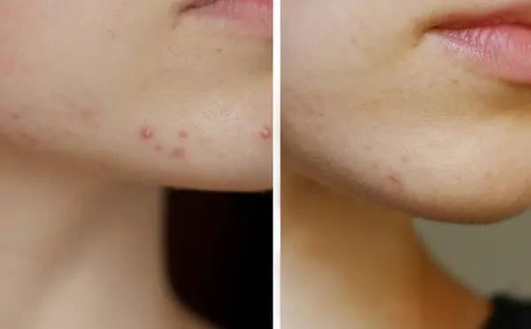 Bir kadında akne tedavisi öncesi ve sonrası kolaj. Önce ve sonra sivilceler. Sorun cilt bakımı.
