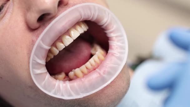 Άνθρωπος Παίρνει Δόντια Του Ελέγχεται Από Έναν Οδοντίατρο Επίσκεψη Στον — Αρχείο Βίντεο