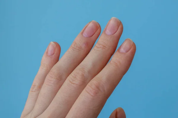질소와 레이저 치료하는 과정에서 여성의 사마귀가 손가락에 나타났습니다 — 스톡 사진