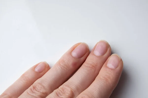 Healing Process Wart Girl Finger — Stock Photo, Image