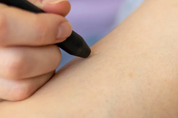 Process of permanent hair removal, removing unwanted hair using an electroepilation device, close-up macro photography. A needle in the skin of the leg