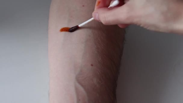 碘在男人手上的皮肤上剥去了皮 一个家庭测试 以确定碘缺乏症 碘网在伤员手上的特写 女人用碘吸引男人 — 图库视频影像