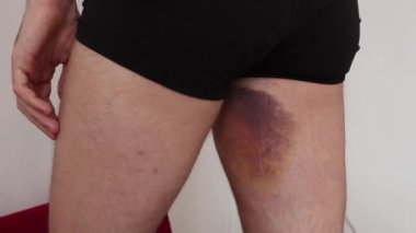 Erkeğin bacağının iç kısmında çok büyük çürükler var. Spor yaparken, futbol oynarken kaza. Mavi, mor, deride sarı leke