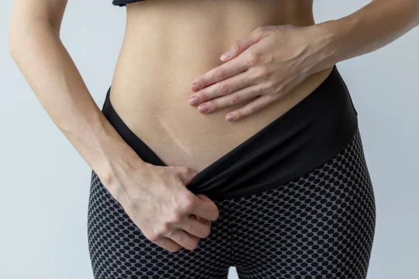 stock image Scar from a healed appendix on a slender young woman