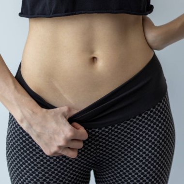 Apandisit ve yara izlerinin evrimi. Apandisit yaralarının iyileşmesi ve küçültülmesi.