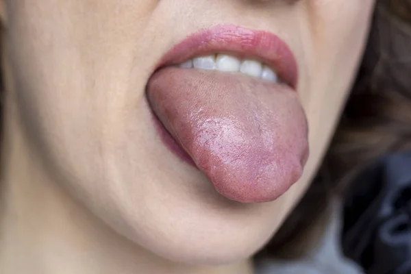 Kobieta Wykazuje Obrzęk Języka Alergii — Zdjęcie stockowe