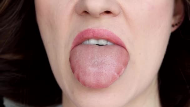 Close Swelling Tongue Allergic Reactions Infections Angioedema Trauma Injury Oral — Stock Video