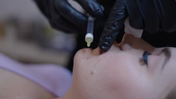 Mujer Rubia Recibe Inyección Ácido Hialurónico Mejilla Izquierda Concepto Salud — Vídeo de stock