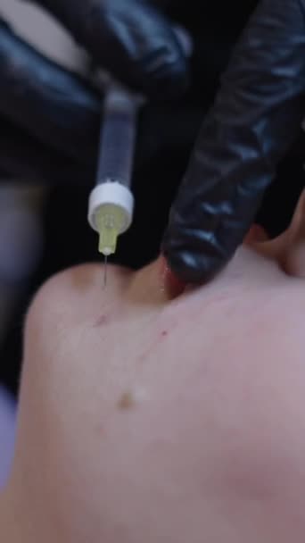 金发妇女左脸颊注射透明质酸 保健概念Fhd垂直注射 — 图库视频影像