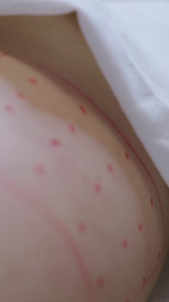 Bir Mezoterapi Hastasının Poposu Fhd Dikey Sağlık Hizmetleri — Stok video