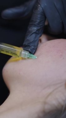 Tıbbi eller hastanın yüzüne prp enjekte ediyor - FHD dikey video
