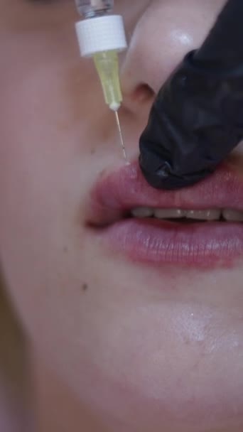 Gros Plan Une Injection Pendant Traitement Acide Hyaluronique Concept Soins — Video