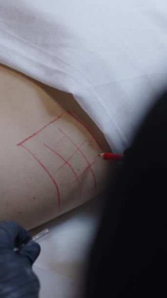 의사는 메소테라피로 치료할 영역을 그리는 장갑으로 Fhd — 비디오