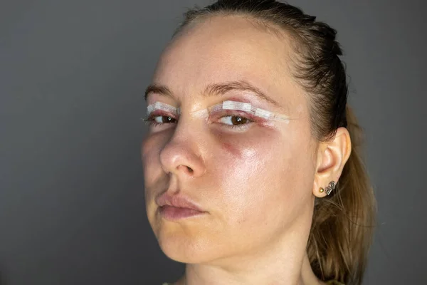 woman face after plastic surgery, blepharoplasty operation, swelling eye bags, incisions with removable stitches, swollen skin and bruised eyelids. Cosmetic surgery to remove excess skin or fat