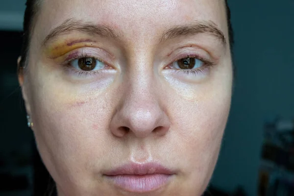 woman face recovery after plastic surgery, blepharoplasty operation, visible eyes wound cuts, swelling eye bags, swollen skin sutures and bruised eyelids. Cosmetic surgery to remove excess skin fat
