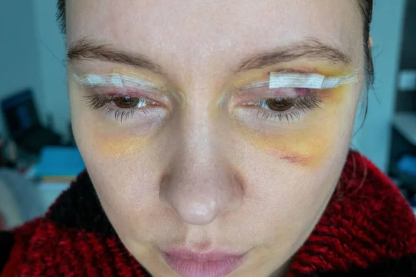 woman face after plastic surgery, yellow skin color bruising, blepharoplasty operation, swelling eye bags, incisions covered with medical tape wound closure strips, swollen skin and bruised eyelids