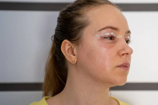 woman face after plastic surgery, blepharoplasty operation, swelling eye bags, incisions with removable stitches, swollen skin and bruised eyelids. Cosmetic surgery to remove excess skin or fat