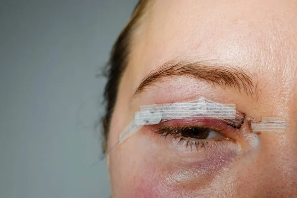 close up woman eyes after plastic surgery, yellow red skin blood bruising, blepharoplasty operation, swollen bruised eyelids, incisions stitches sutures covered with medical tape, wound closure strips