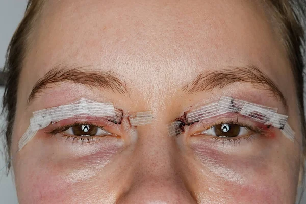 close up woman eyes after plastic surgery, yellow red skin blood bruising, blepharoplasty operation, swollen bruised eyelids, incisions stitches sutures covered with medical tape, wound closure strips