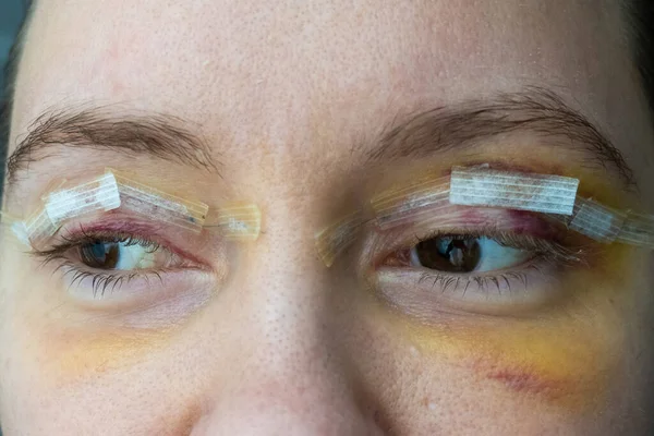 close up woman eyes after plastic surgery, yellow red skin bruising, blepharoplasty operation, swollen bruised eyelids, incisions stitches covered with medical tape, wound closure strips