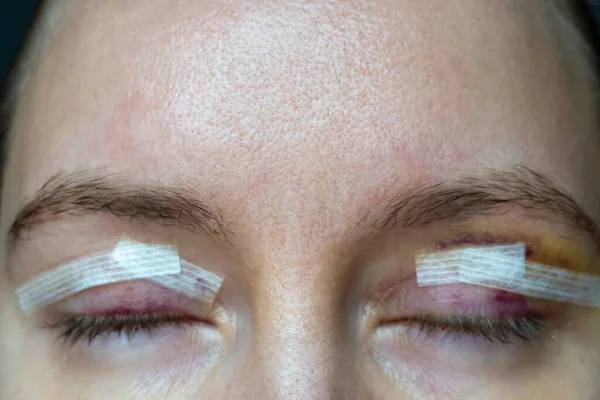 close up woman eyes after plastic surgery, yellow red skin bruising, blepharoplasty operation, swollen bruised eyelids, incisions stitches covered with medical tape, wound closure strips