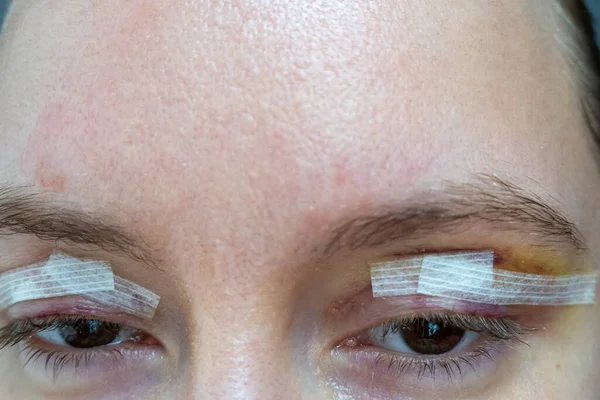 close up woman eyes after plastic surgery, yellow red skin bruising, blepharoplasty operation, swollen bruised eyelids, incisions cuts covered with medical tape, wound closure strips