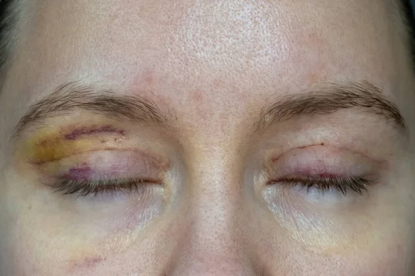 woman face recovery after plastic surgery, blepharoplasty operation, visible eyes wound cuts, swelling eye bags, swollen skin sutures and bruised eyelids. Healing process of creases