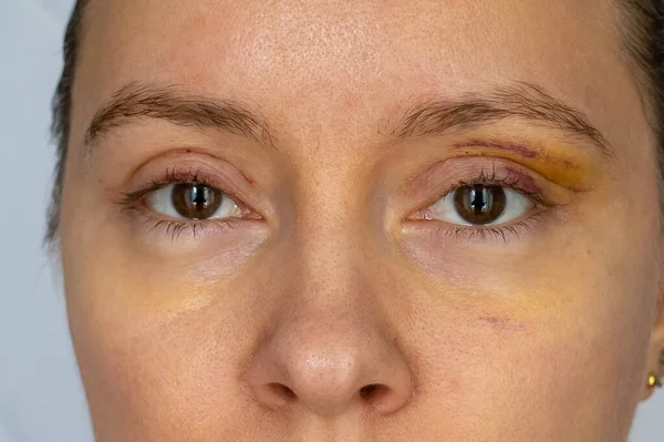 woman face recovery after plastic surgery, blepharoplasty operation, visible eyes wound cuts, swelling eye bags, swollen skin sutures and bruised eyelids. Healing process of creases