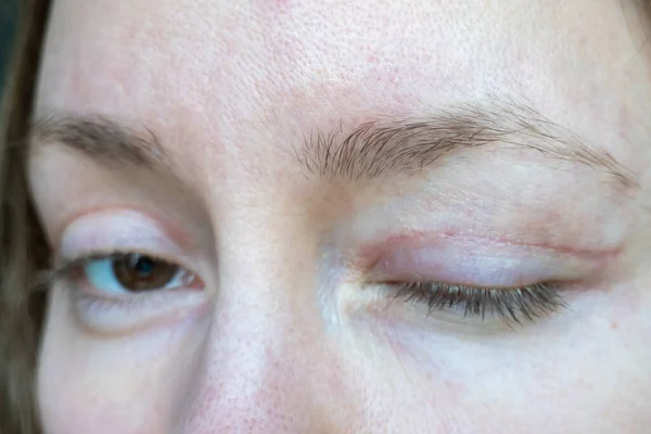 woman face after plastic surgery on eyes, blepharoplasty operation, incisions stitches, healing after operation, scar from surgical cut on eyelid, healed wound skin