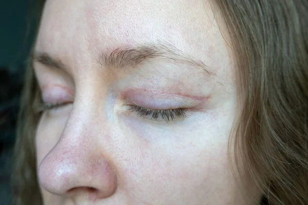 Γυναίκα Πρόσωπο Μετά Από Πλαστική Χειρουργική Επέμβαση Στα Μάτια Βλεφαροπλαστική — Φωτογραφία Αρχείου