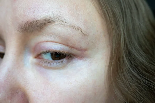 Frauengesicht Nach Schönheitsoperation Den Augen Blepharoplastik Operation Schnittwunden Heilung Nach — Stockfoto