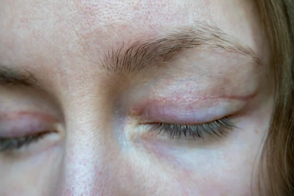 woman face after plastic surgery on eyes, blepharoplasty operation, incisions stitches, healing after operation, scar from surgical cut on eyelid, healed wound skin