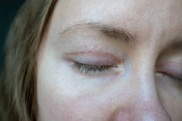 Cara Mujer Después Cirugía Plástica Los Ojos Blefaroplastia Operación Incisiones —  Fotos de Stock