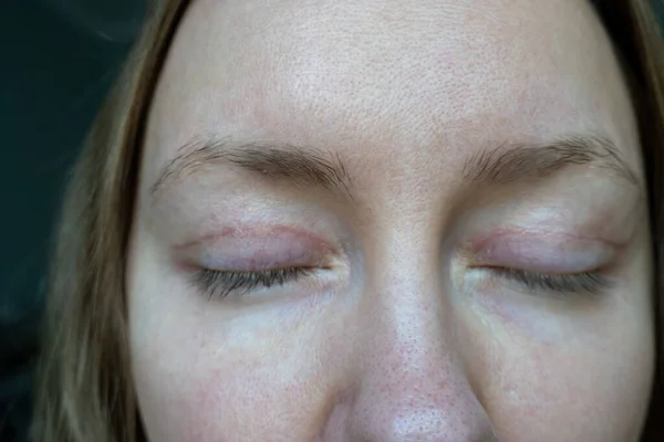 Γυναίκα Πρόσωπο Μετά Από Πλαστική Χειρουργική Επέμβαση Στα Μάτια Βλεφαροπλαστική — Φωτογραφία Αρχείου