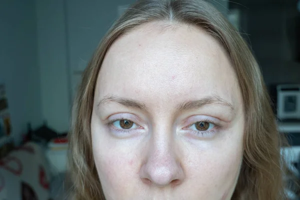 Rosto Mulher Após Cirurgia Plástica Nos Olhos Operação Blefaroplastia Pontos — Fotografia de Stock