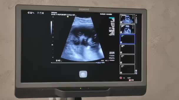 ワルシャワポーランド 2024 胎児の映像が付いている超音波モニター 赤ちゃんの映像が付いている超音波装置 妊娠中の女性患者の体の医学検査 新しい生命胚 — ストック動画