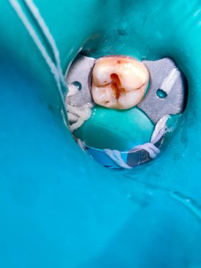 Diş protezleriyle diş tedavisi