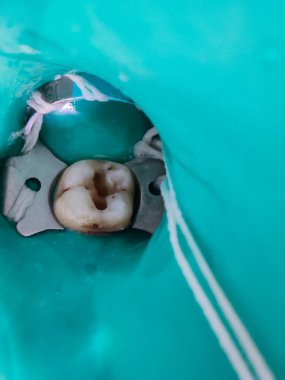 Diş implantını kapat