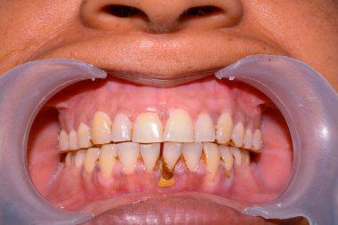 Dişlerinde matematik olan bir hasta.