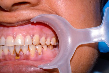 Dişlerinde matematik olan bir hasta.