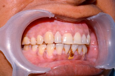 Dişlerinde matematik olan bir hasta.