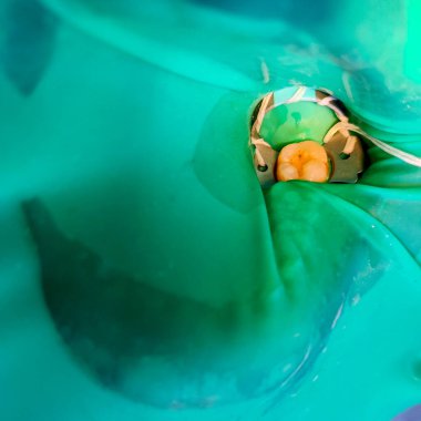 Birleşik restorasyon için arka dişlerdeki kauçuk baraj izolasyonunun seçici odak resmi