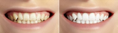 Kadın Dişleri Beyazlamadan Önce ve Sonra. Sağlıklı Dişlerle Kusursuz Gülümse. Diş Kliniği Hastası. Ağız Bakımı Diş Hekimliği ve Stomatoloji