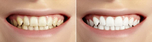 Woman Teeth Before and After Whitening. Perfect Smile with Healthy Teeth. Dental Clinic Patient. Oral Care Dentistry and Stomatology