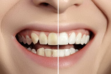 Kadın Dişleri Beyazlamadan Önce ve Sonra. Sağlıklı Dişlerle Kusursuz Gülümse. Diş Kliniği Hastası. Ağız Bakımı Diş Hekimliği ve Stomatoloji